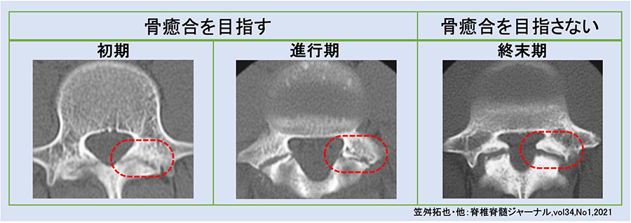 腰椎分離症ってなぁに?