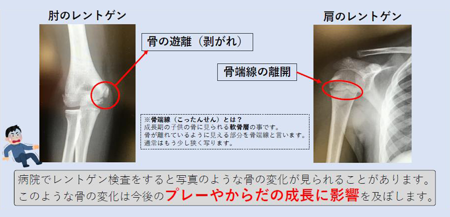 投球障害の特徴